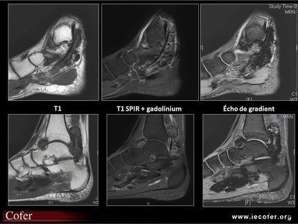 Synovite villonodulaire pigmentée: IRM